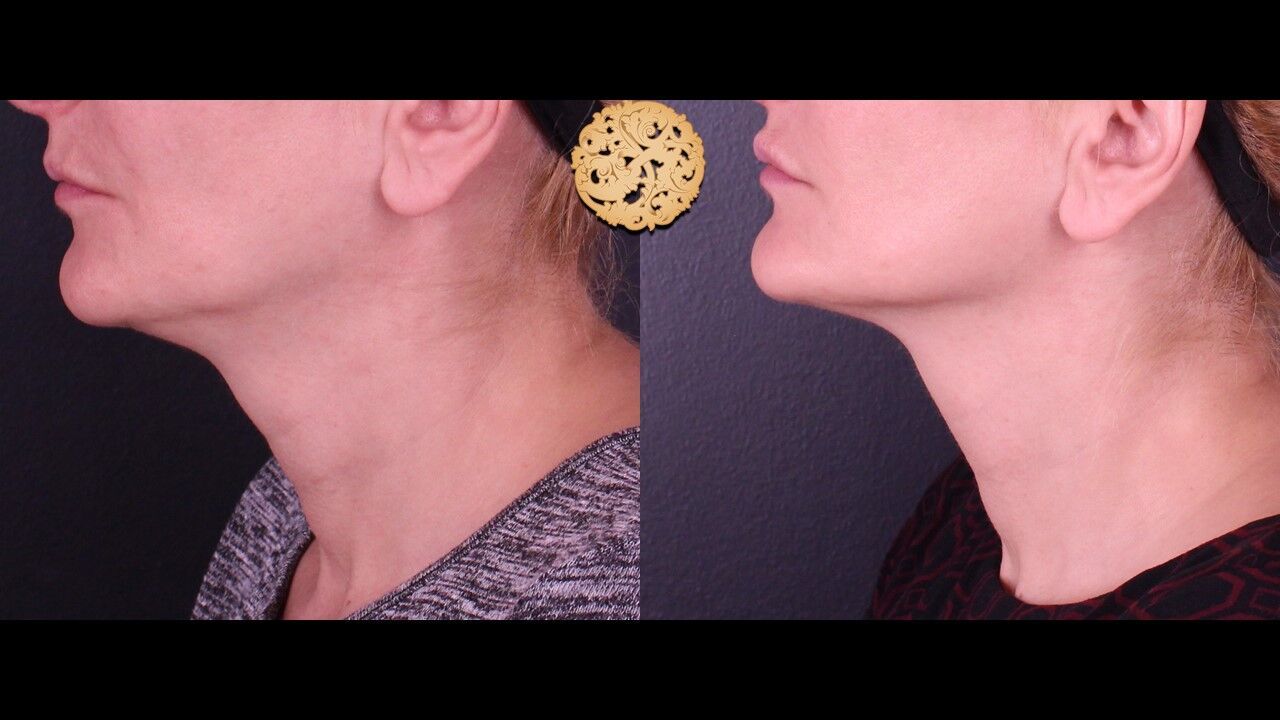 Lip Filler Before & After