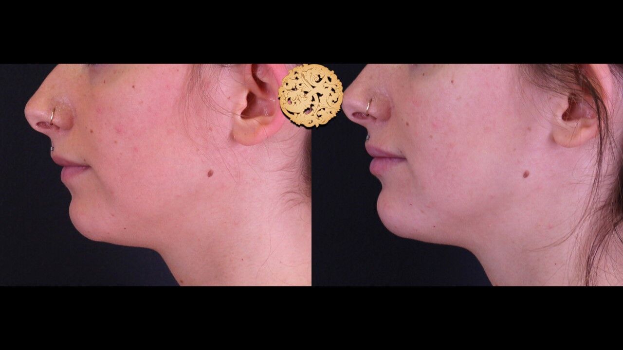 Lip Filler Before & After