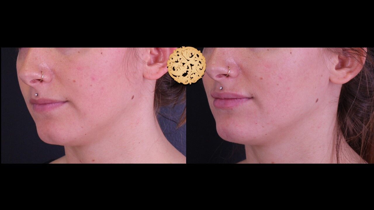 Lip Filler Before & After