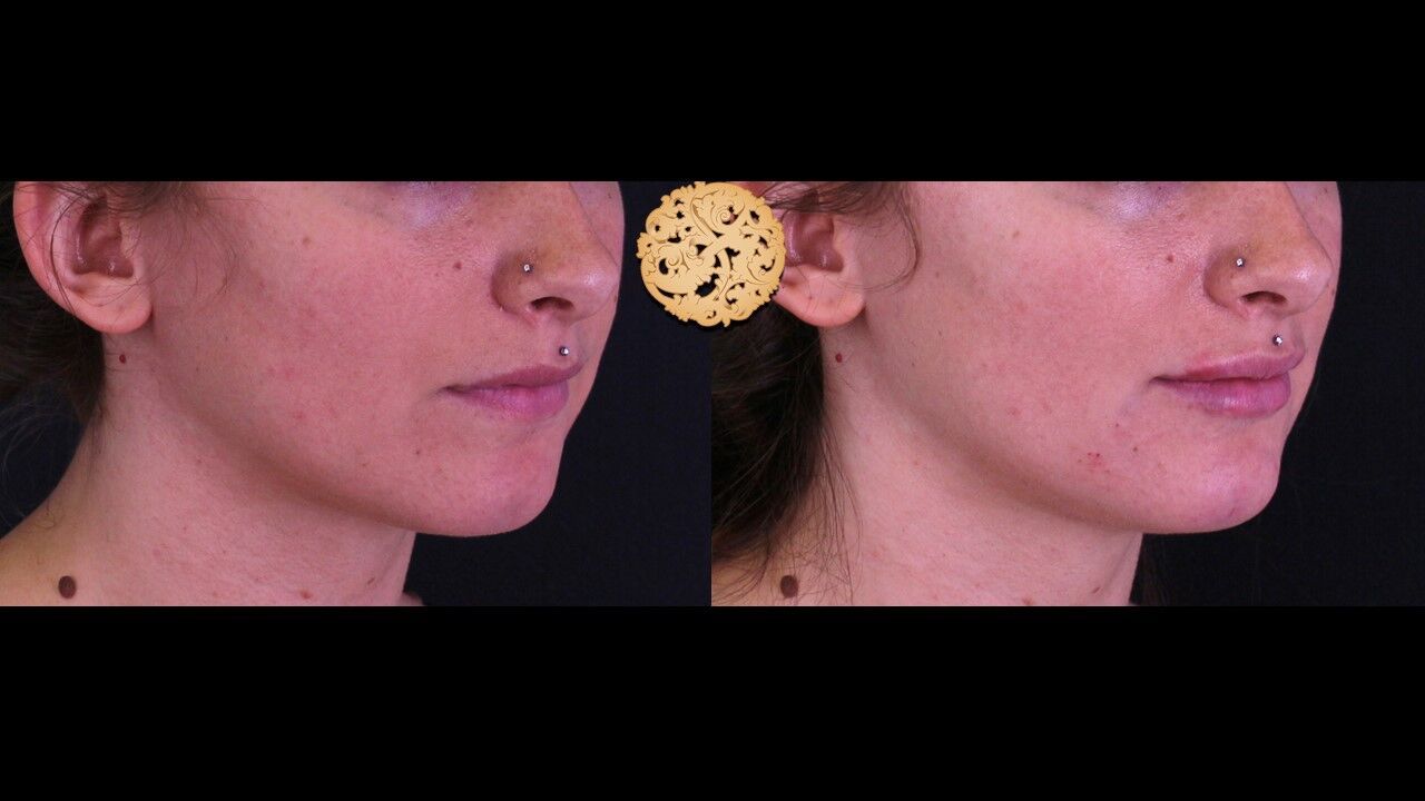 Lip Filler Before & After