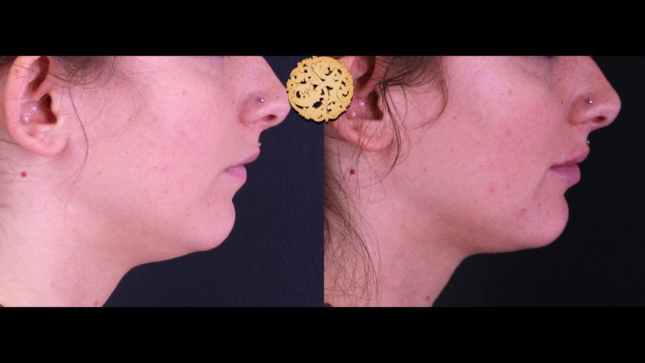 Lip Filler Before & After