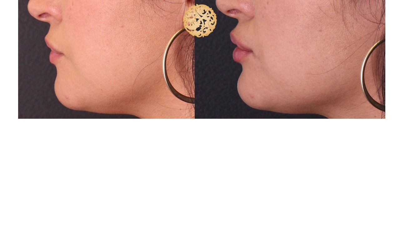 Lip Filler Before & After