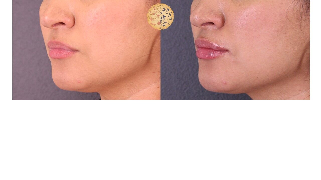 Lip Filler Before & After