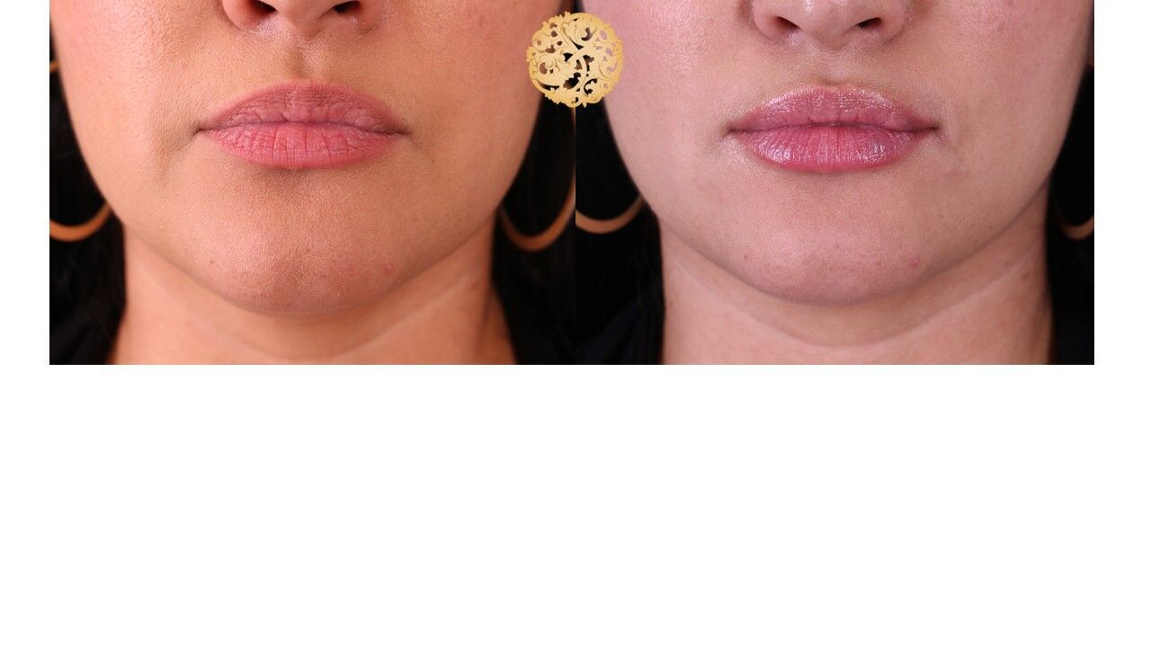 Lip Filler Before & After