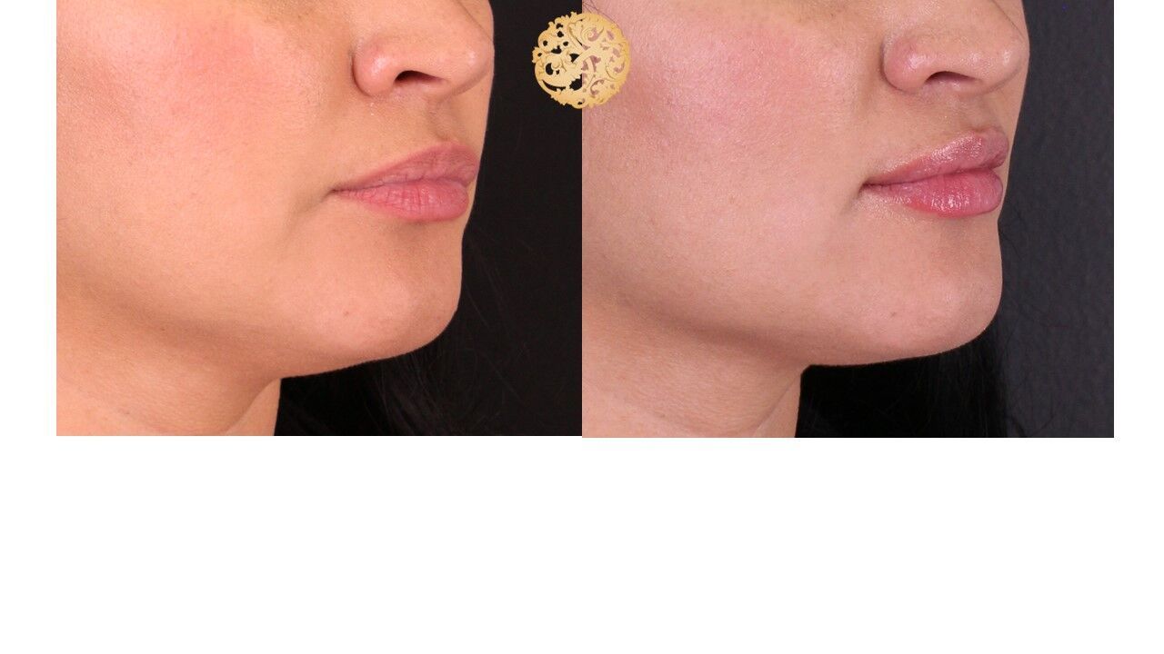 Lip Filler Before & After