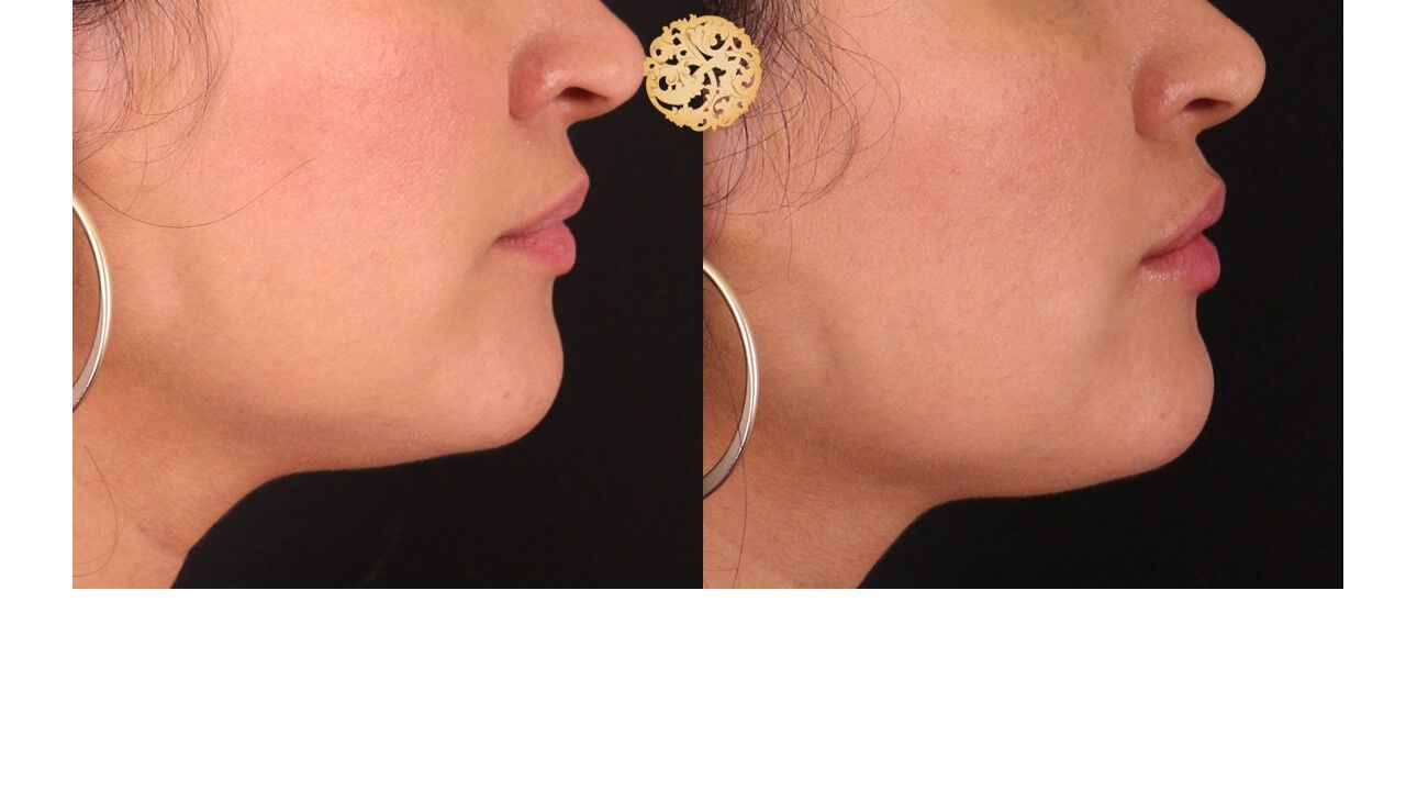 Lip Filler Before & After