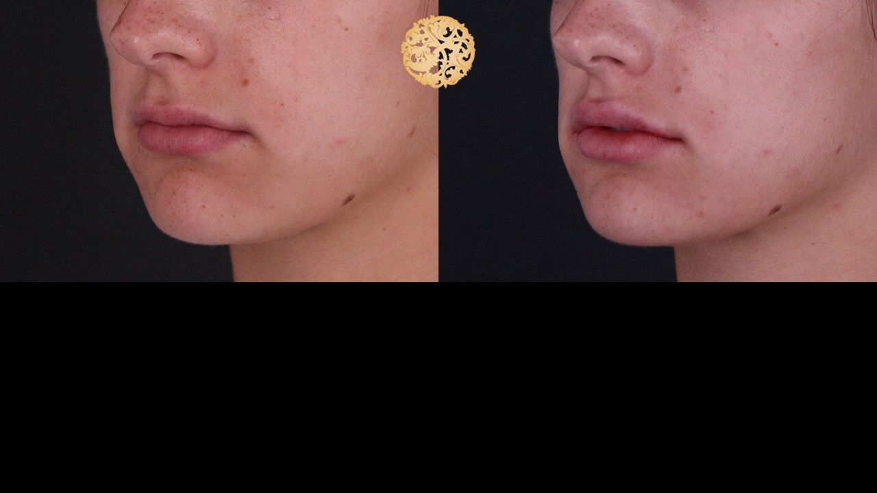 Lip Filler Before & After