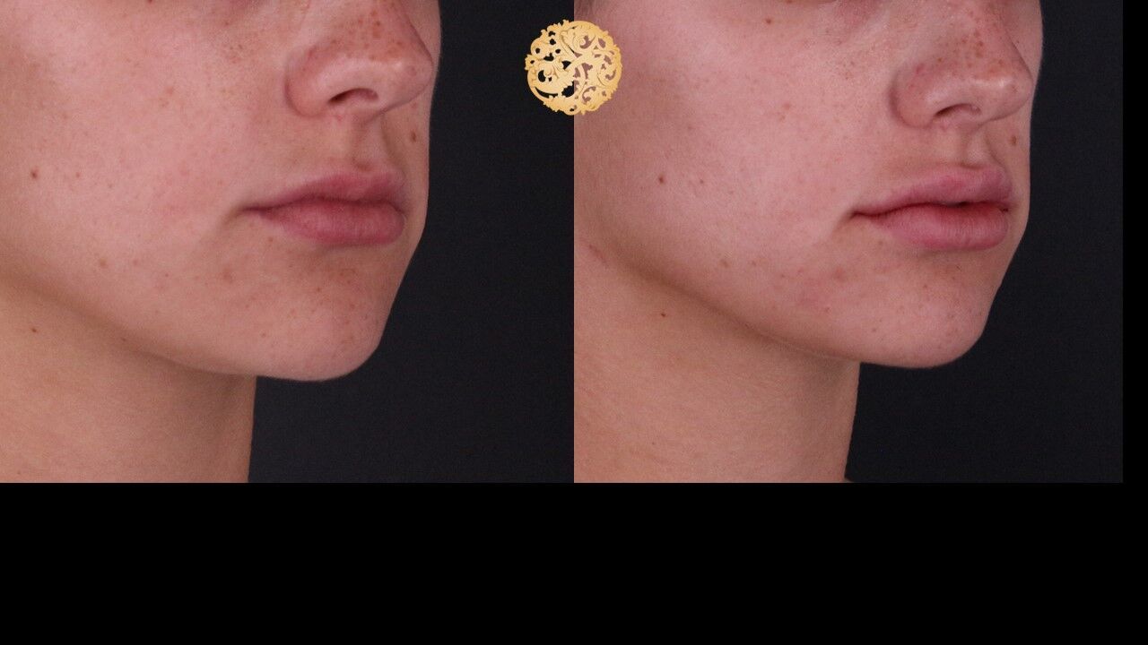 Lip Filler Before & After