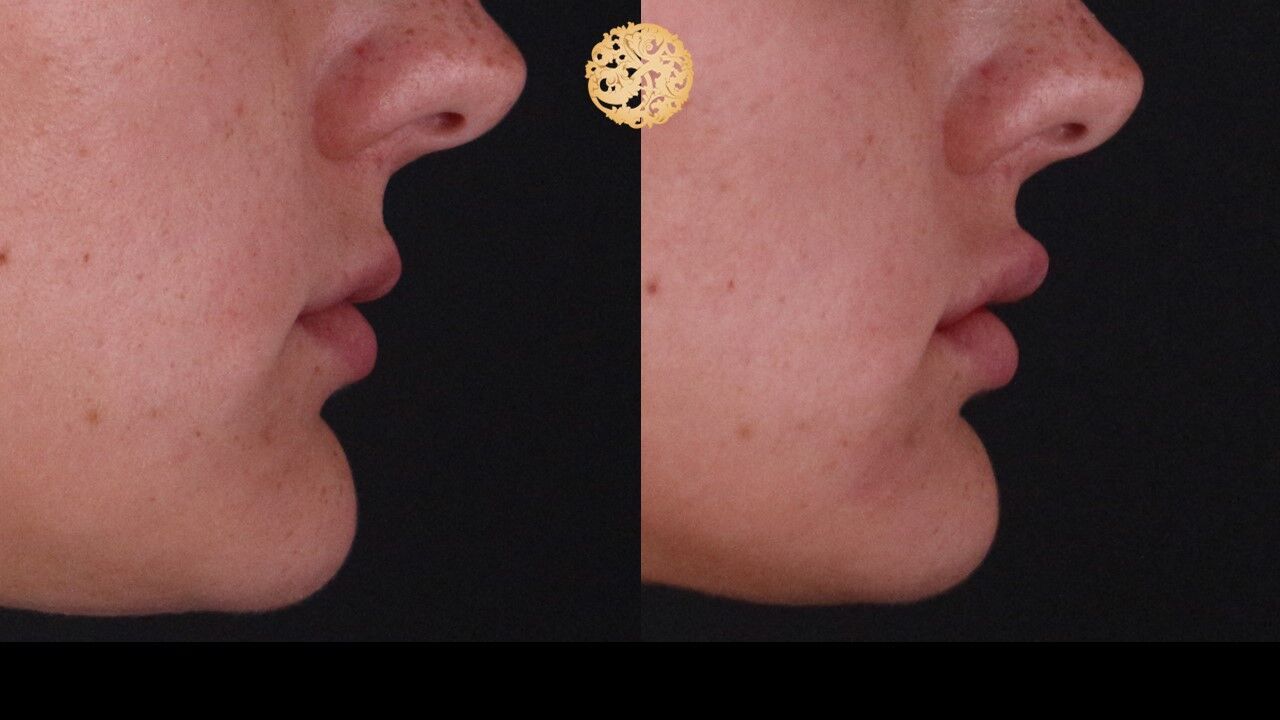 Lip Filler Before & After