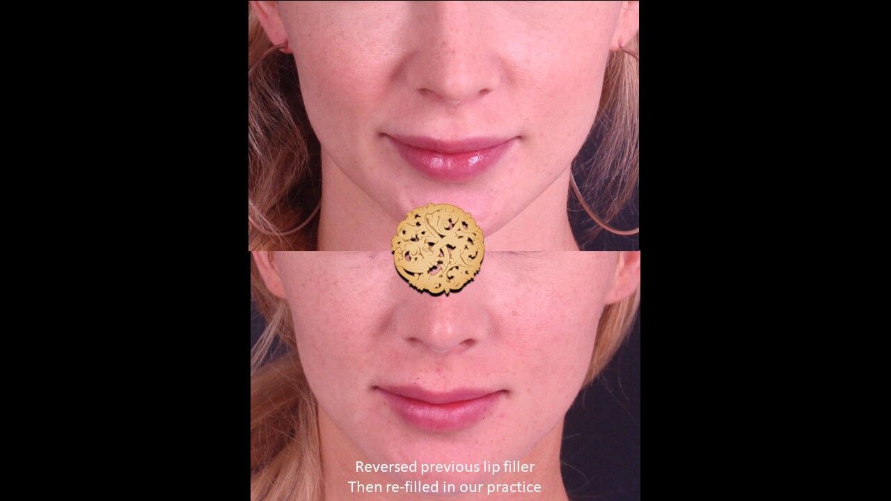 Lip Filler Before & After