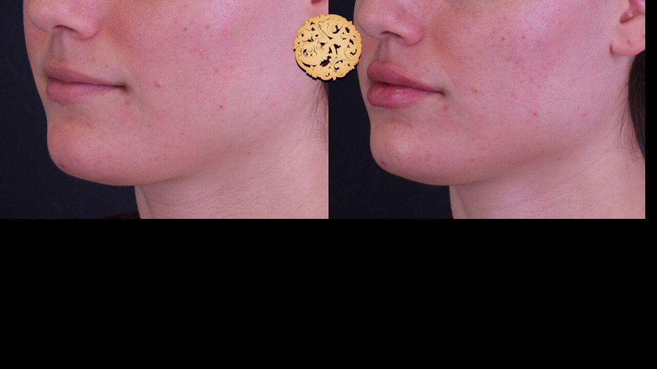 Lip Filler Before & After