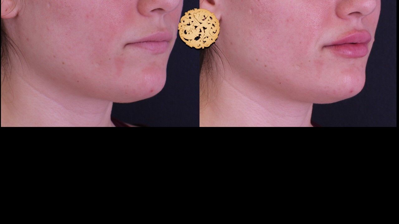 Lip Filler Before & After