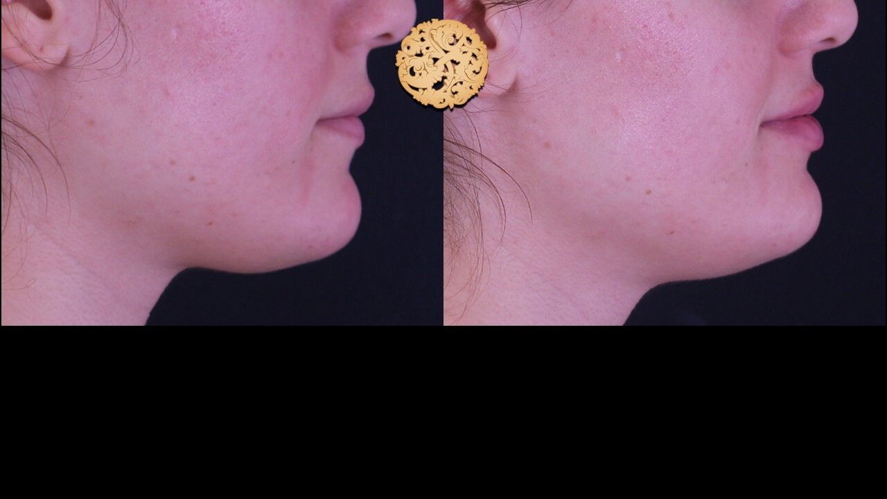 Lip Filler Before & After