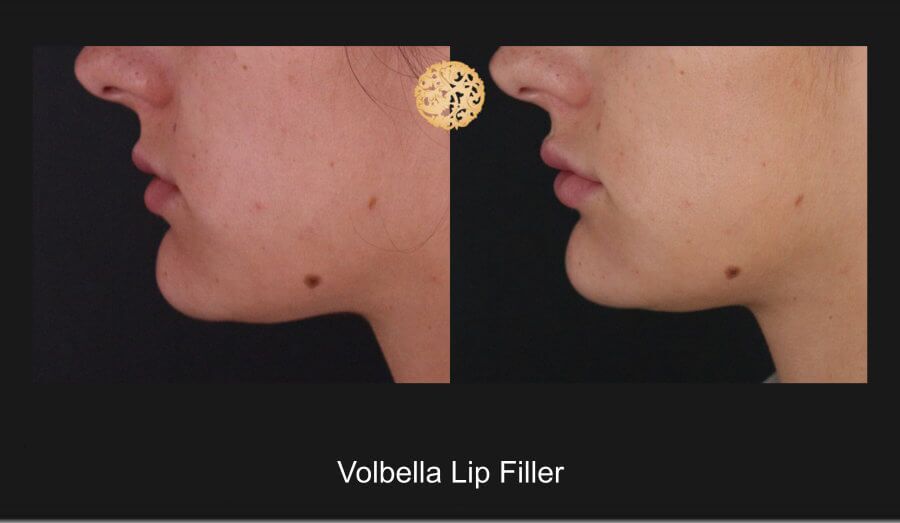 Lip Filler Before & After