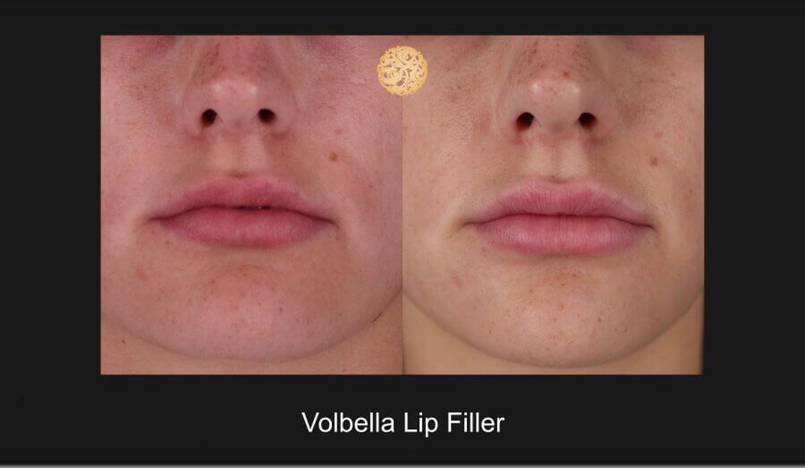 Lip Filler Before & After