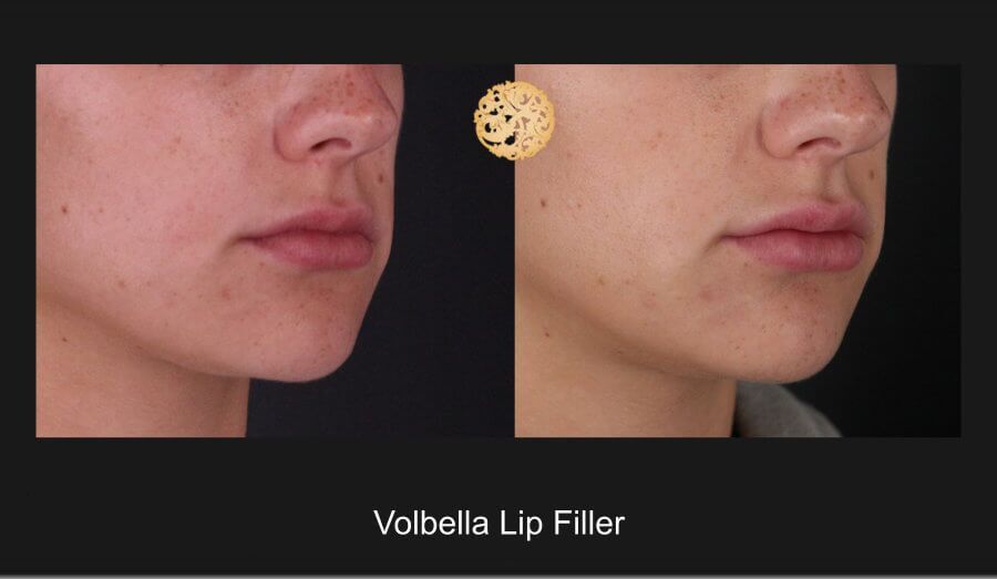 Lip Filler Before & After