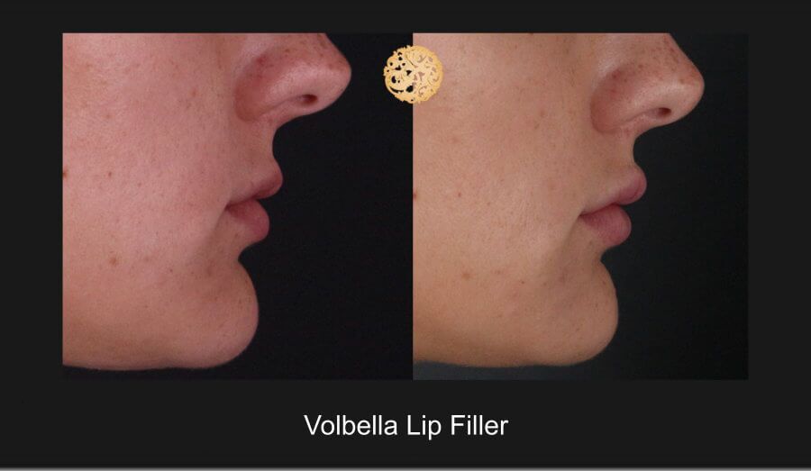 Lip Filler Before & After