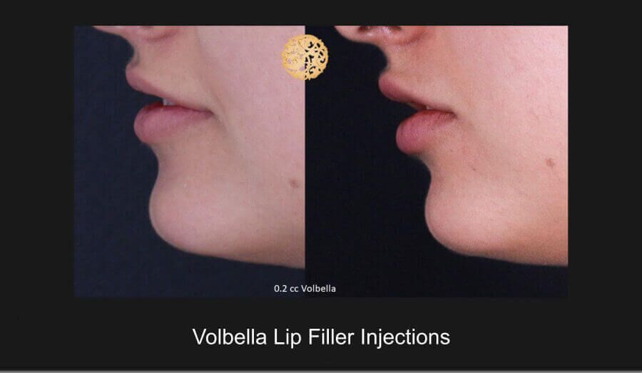 Lip Filler Before & After