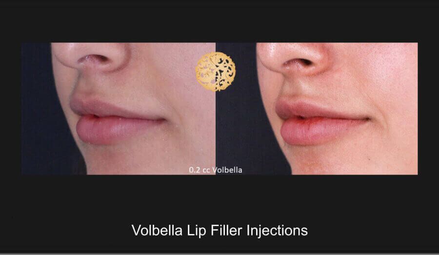 Lip Filler Before & After
