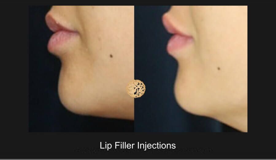 Lip Filler Before & After