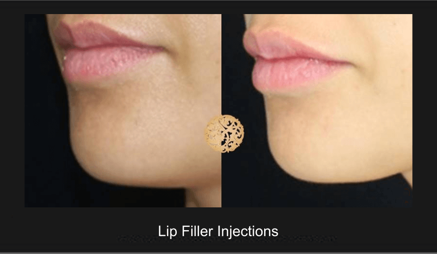 Lip Filler Before & After