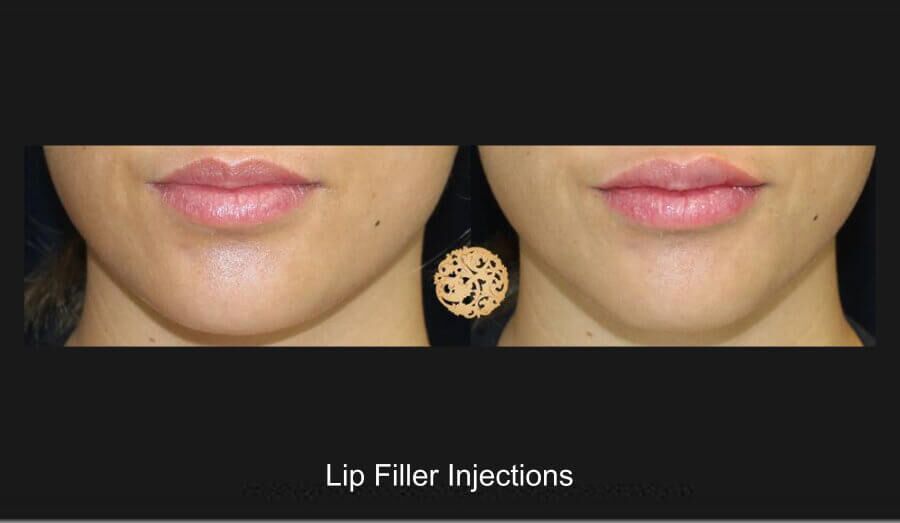 Lip Filler Before & After