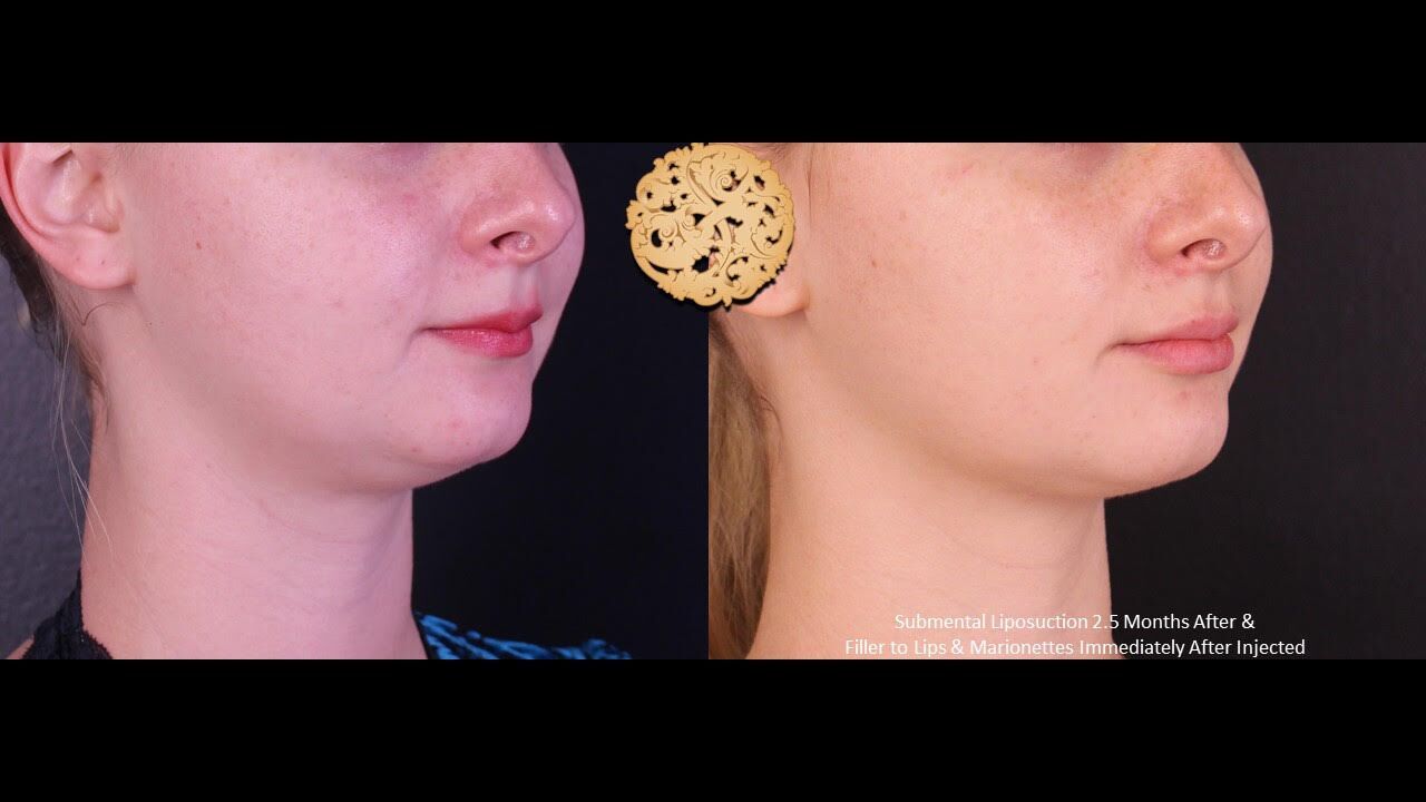 Lip Filler Before & After