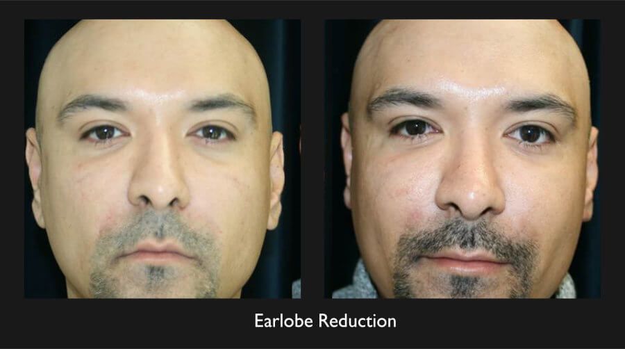 Earlobe Reduction Before & After