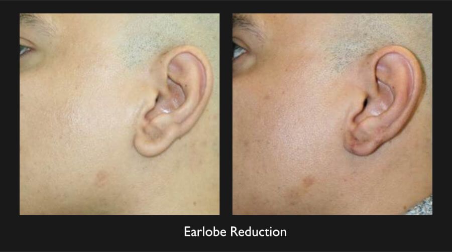Earlobe Reduction Before & After