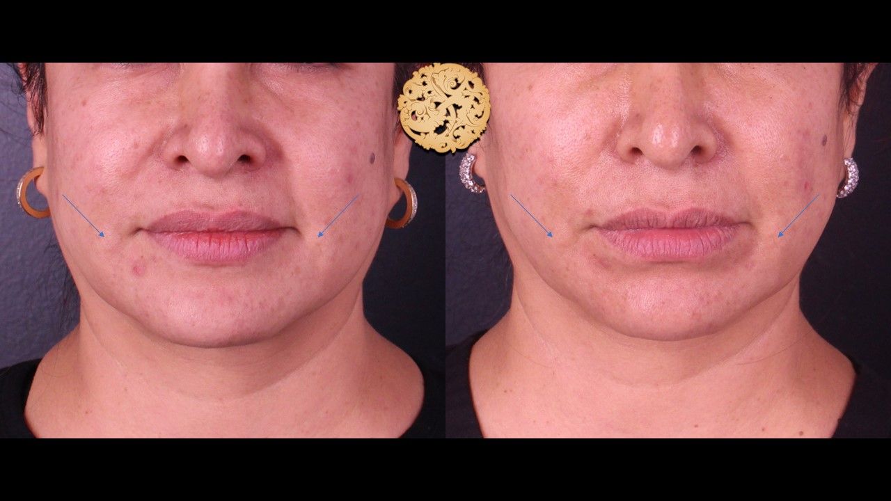 Kybella Before & After