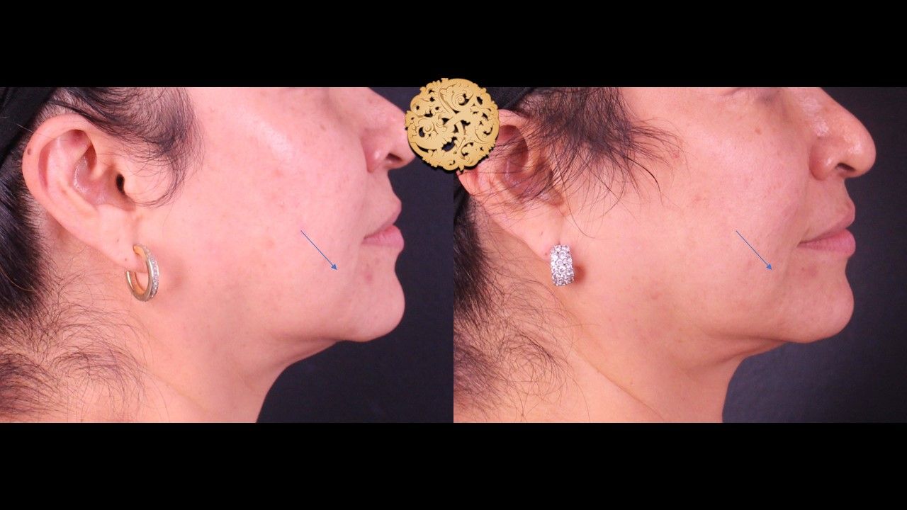 Kybella Before & After