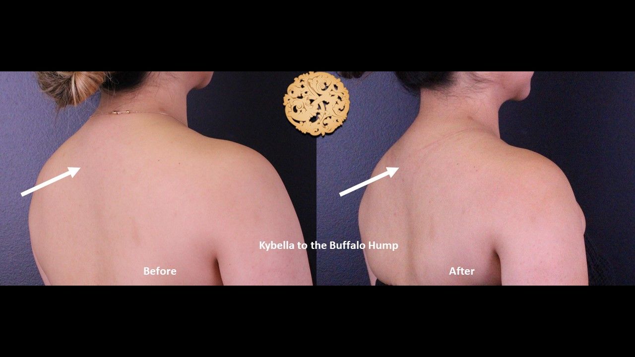 Kybella Before & After