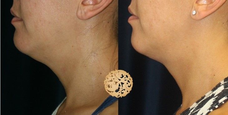 Kybella Before & After