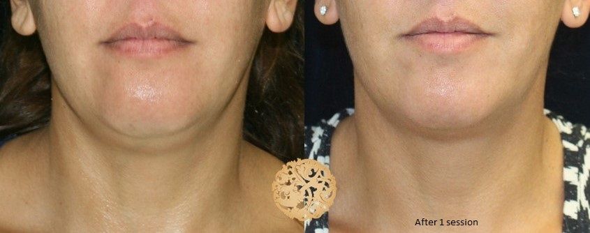 Kybella Before & After
