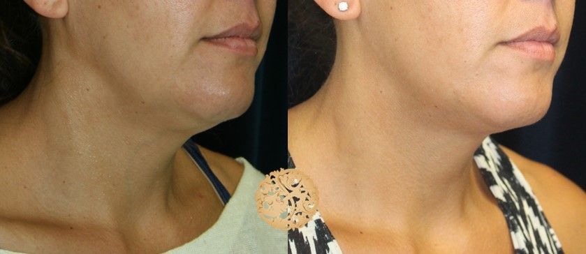 Kybella Before & After