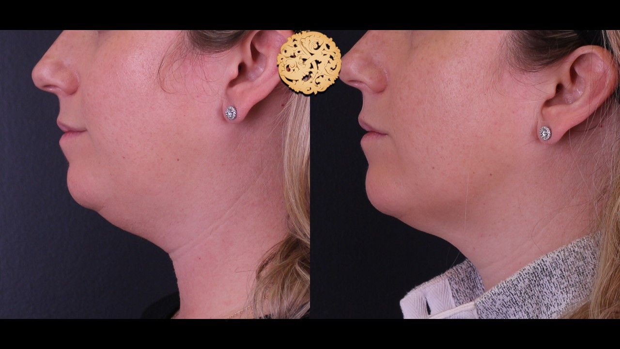 Kybella Before & After