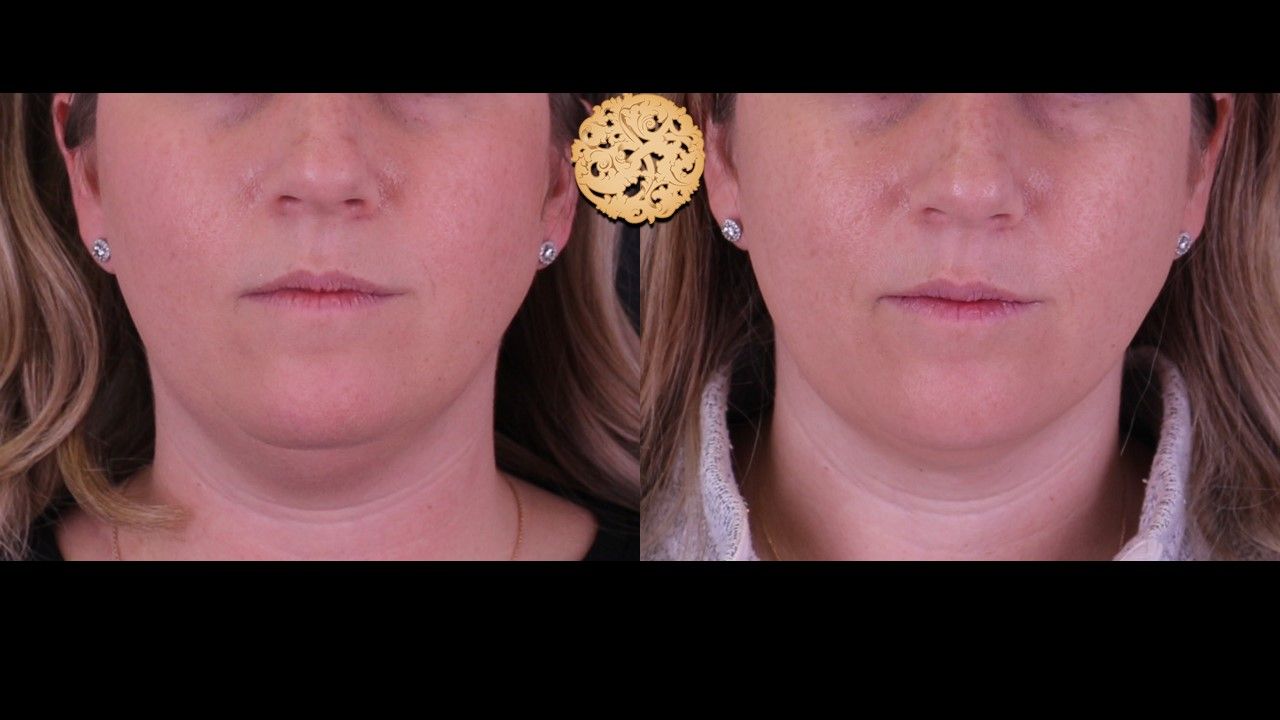 Kybella Before & After