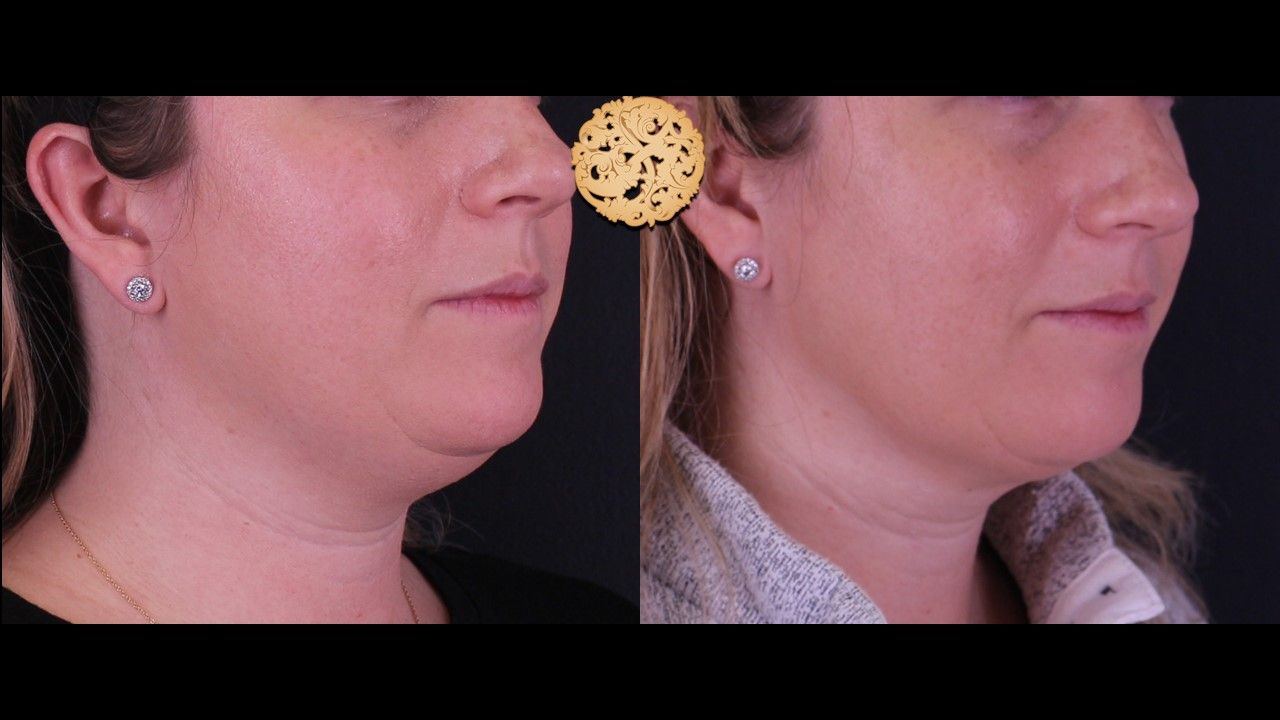 Kybella Before & After