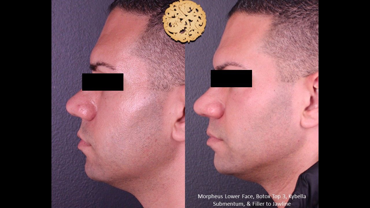 Kybella Before & After