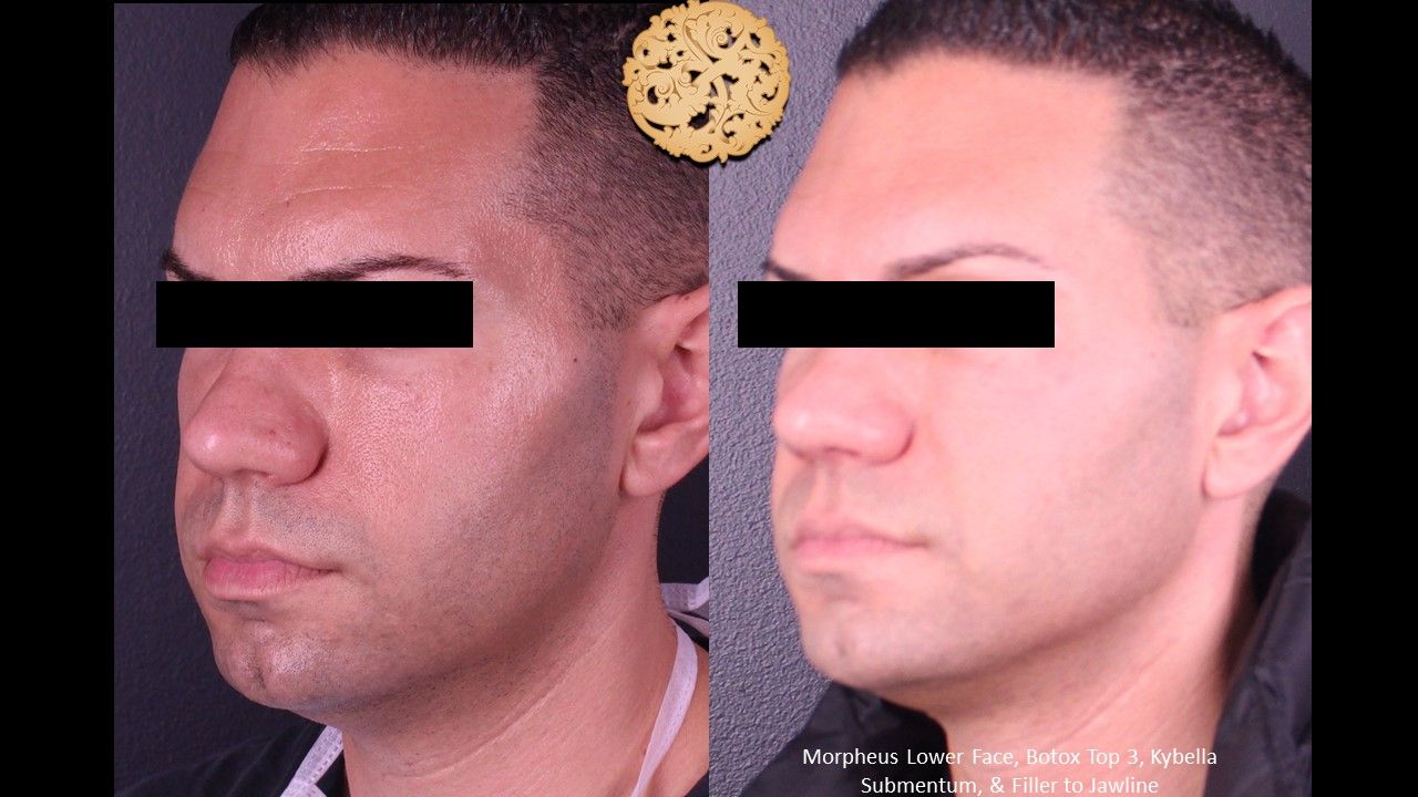 Kybella Before & After