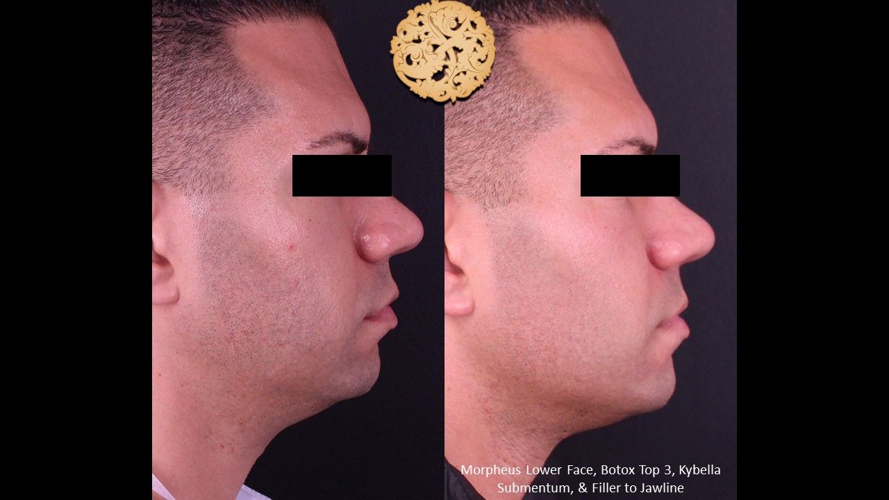 Kybella Before & After