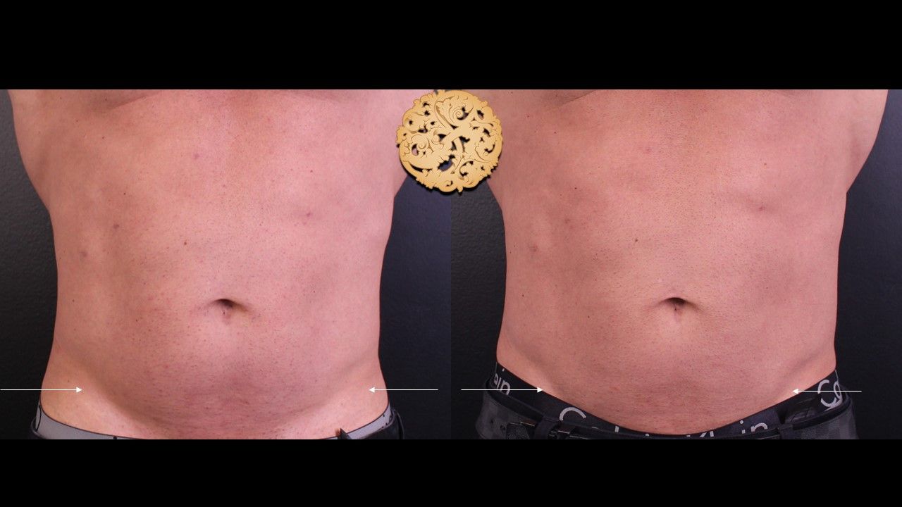 Kybella Before & After