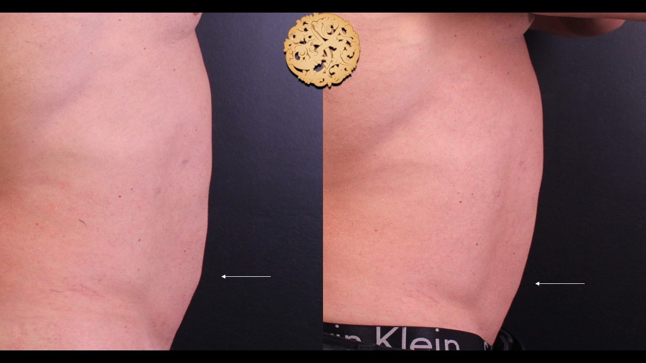 Kybella Before & After