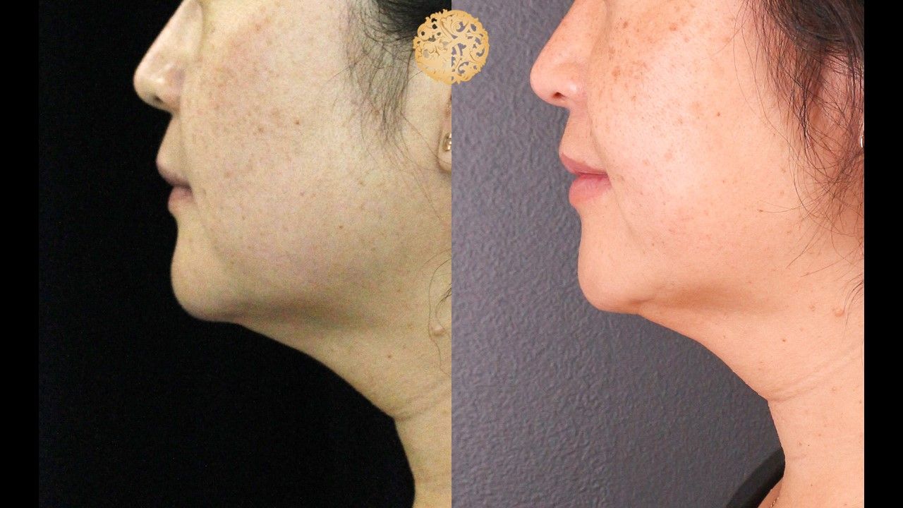 Kybella Before & After