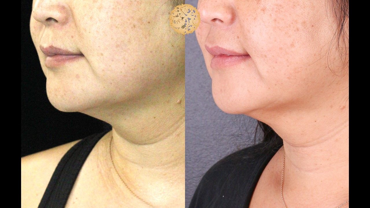 Kybella Before & After