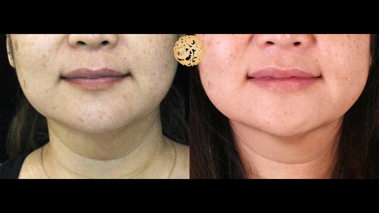 Kybella Before & After