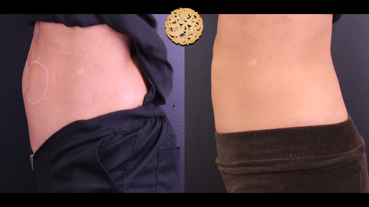 Kybella Before & After