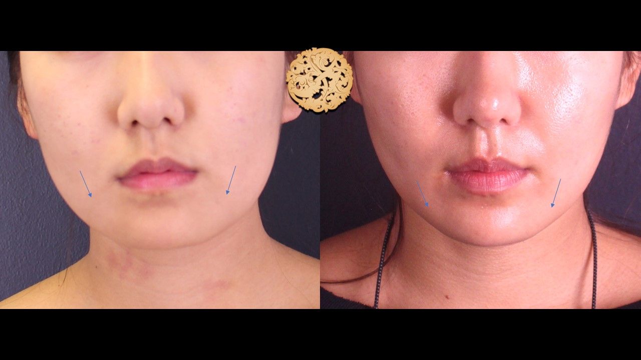 Kybella Before & After