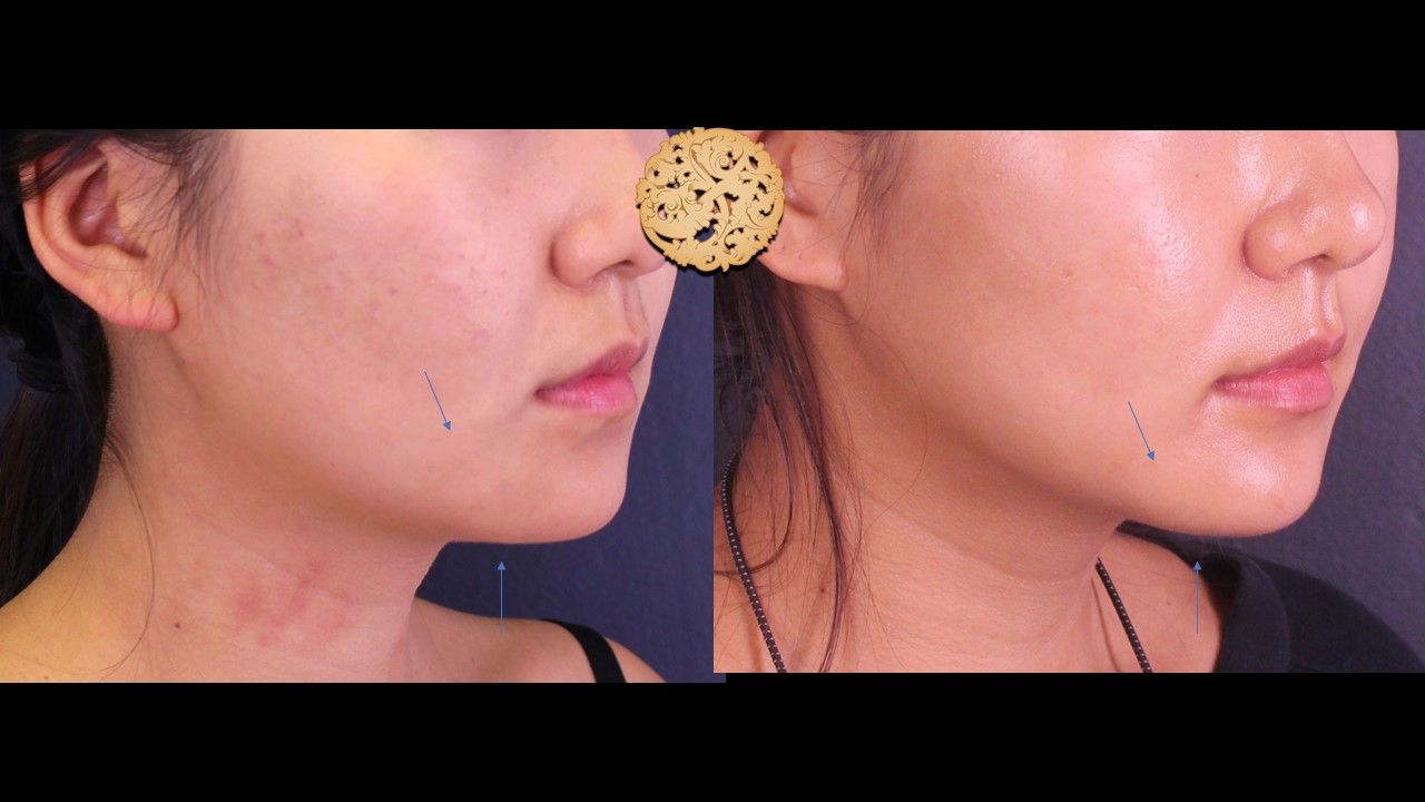 Kybella Before & After