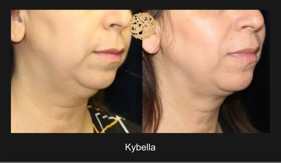 Kybella Before & After
